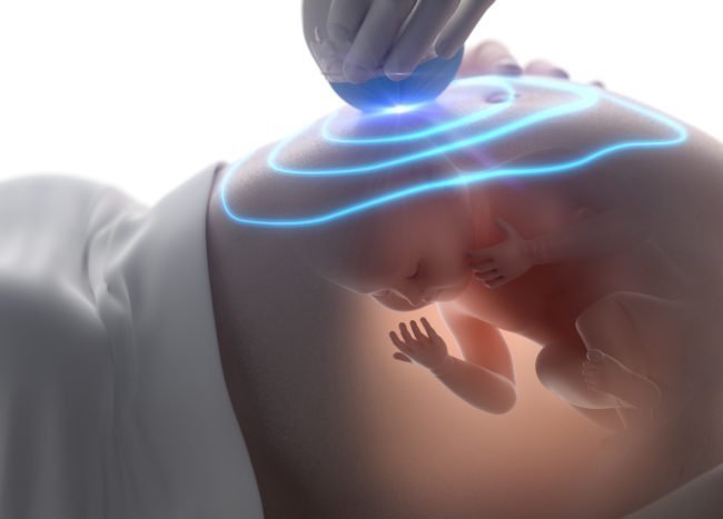 Sàng lọc trước sinh và sơ sinh để tránh hậu quả nặng nề do dị tật